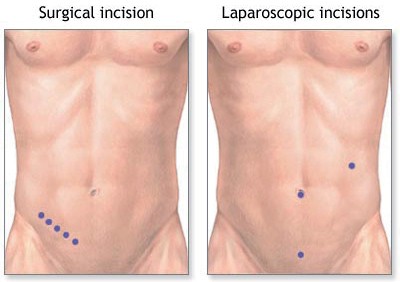 Appendisectomy_Laparoscopic_Jan_2019_001